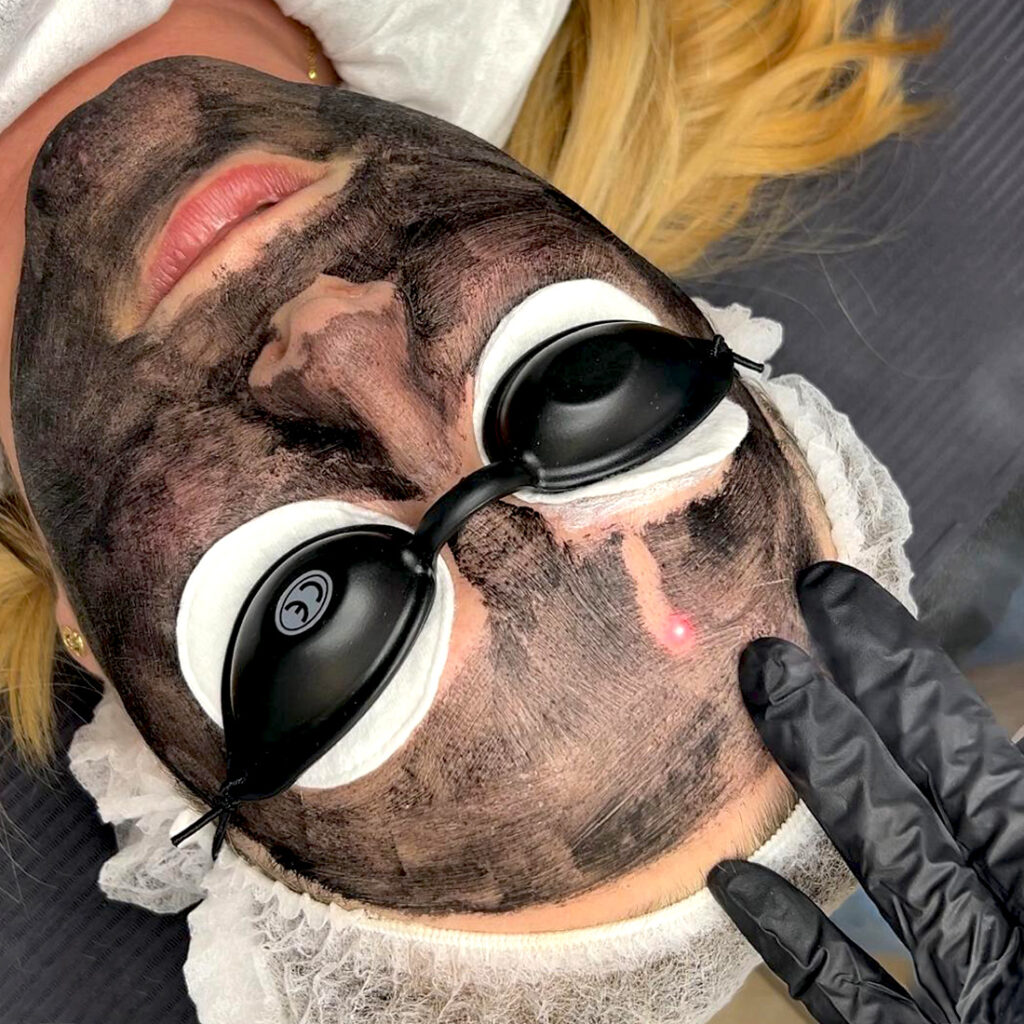 Peeling węglowy laser Monika Gryska Jendryca